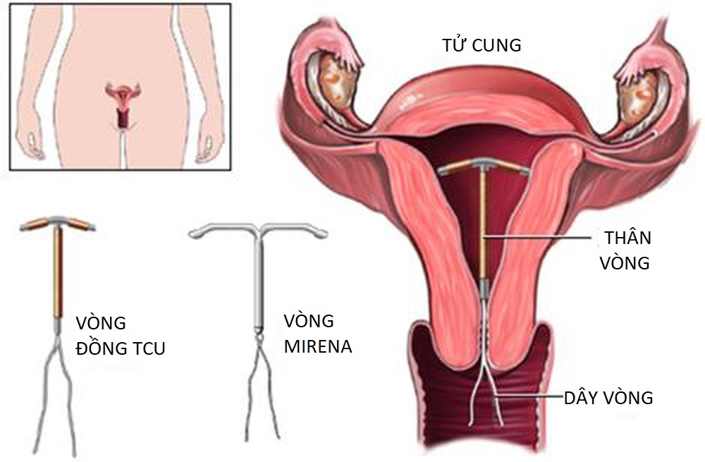 Biện pháp tránh thai