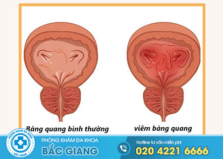 nguyen-nhan-viem-bang-quang